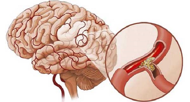 Bệnh tai biến mạch máu não là gì?