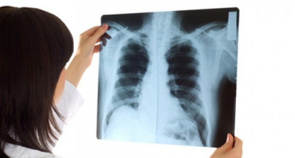 Nguyên nhân, dấu hiệu biểu hiện và cách chữa bệnh ung thư phổi