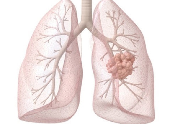 Những dấu hiệu nhận biết ung thư phổi
