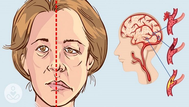 Các di chứng có thể gặp phải sau tai biến mạch máu não